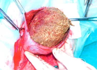 Безоарная болезнь 