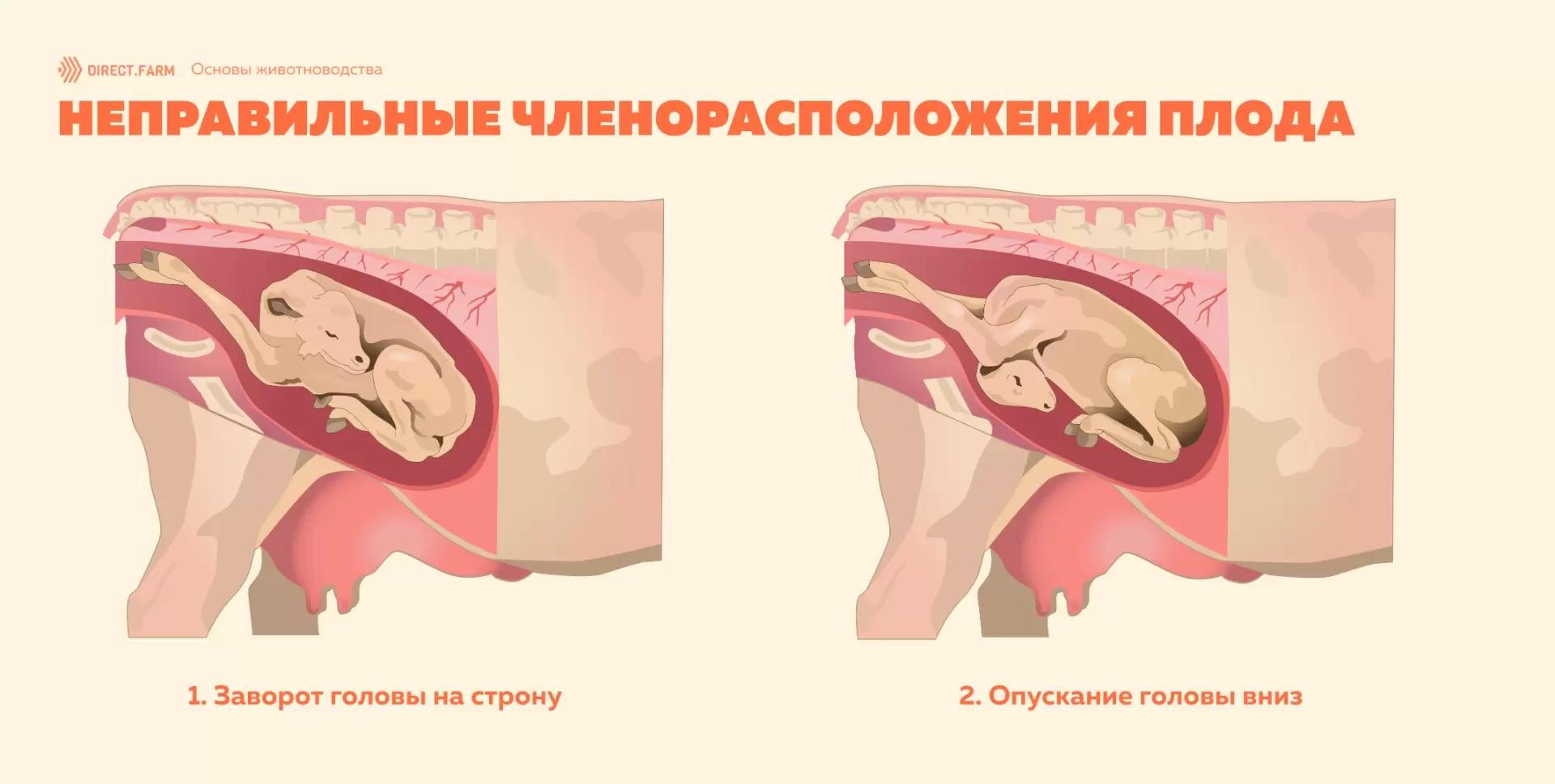 Неправильные членорасположения плода: заворот головы на сторону и опускание вниз
