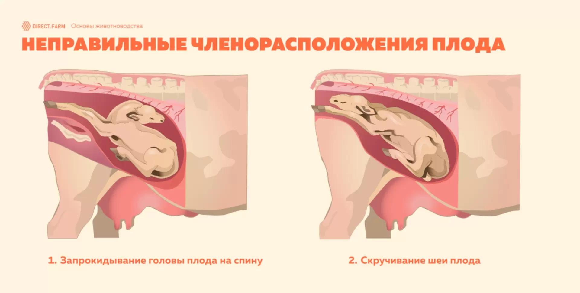 Членорасположения плода: запрокидывание головы на спину и скручивание шеи