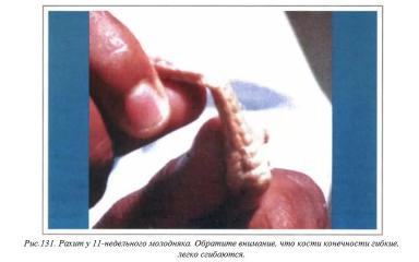 Вегад - Атлас болезней птицы. Ч. 26. Рахит