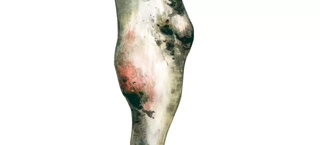 Предплюсневый асептический бурсит, целлюлит КРС