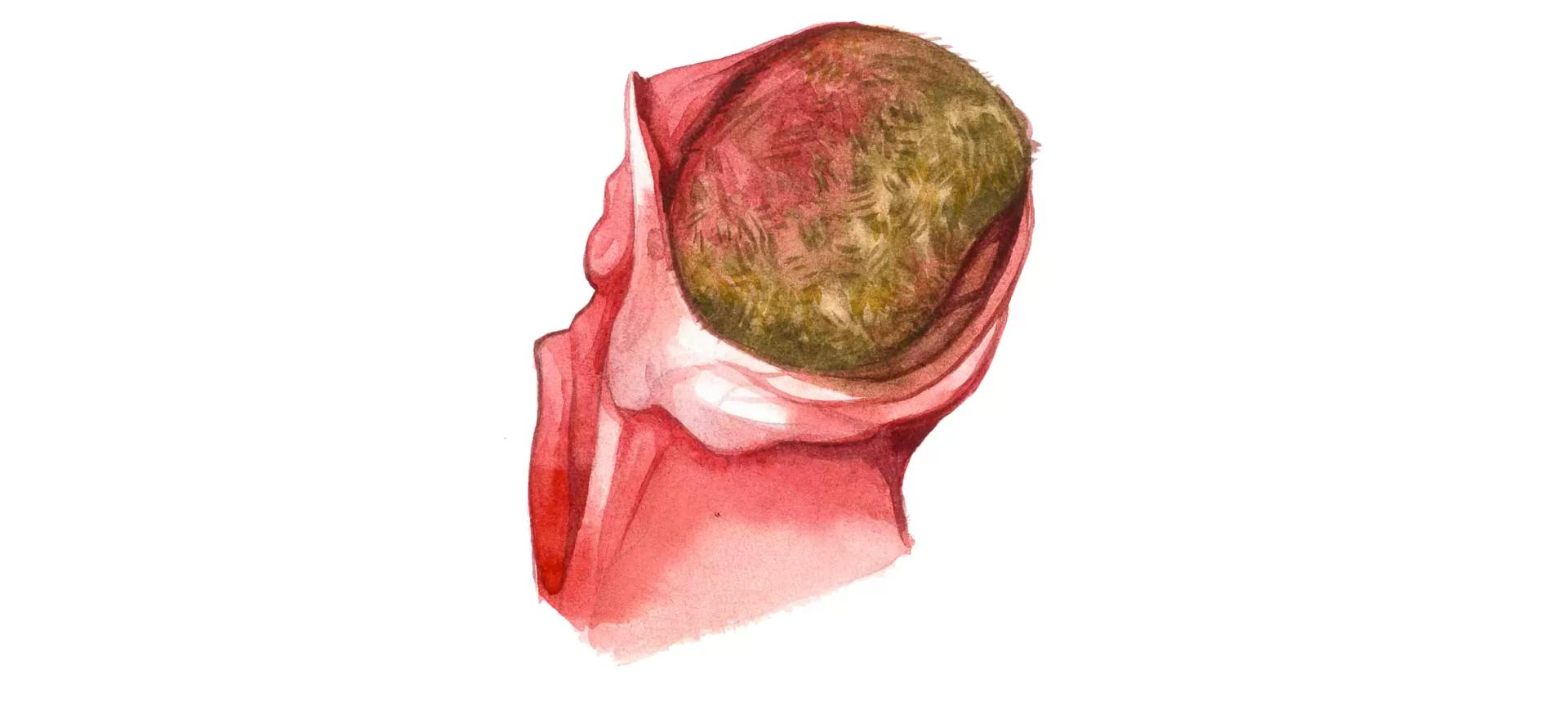 Безоарная болезнь