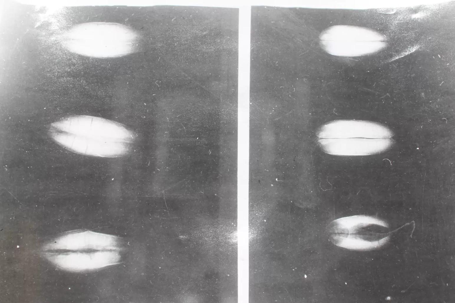 Энзимо- микозное истощение зерна (ЭМИС) – Симптомы и диагностика