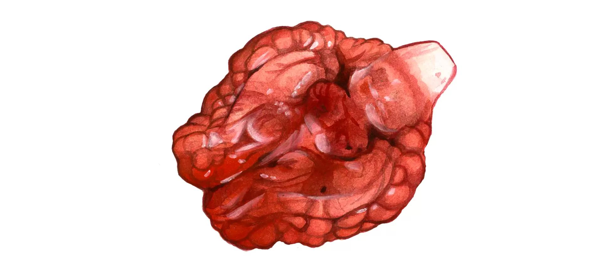 Гистофилез (гемофилез) КРС
