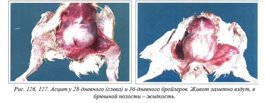 Генетические факторы, приводящие к асциту